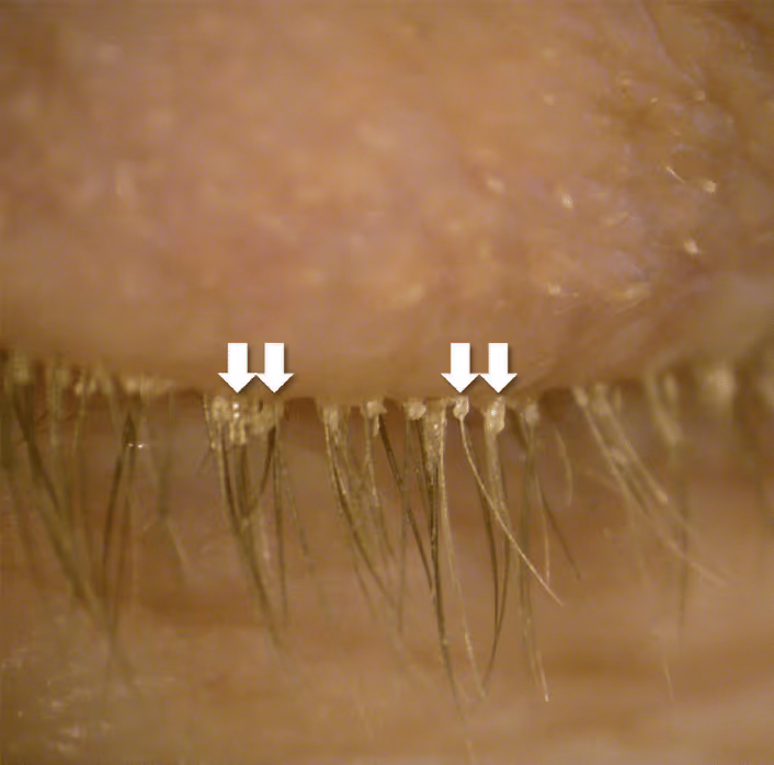 Colarettes cilíndricos na base dos cílios — sinal patognomônico de blefarite por Demodex.