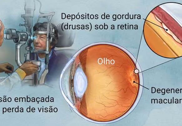 Imagem exemplificando os sinais e sintomas de Drusas com Degeneração Macular relacionada à idade. Mostra o depósito de gordura (drusas) sob a retina dos olhos do paciente. Esta doença causa perda de visão do centro da visão, pode causar visão embaçada ou perda de visão central com mancha (escotoma). Ao lado mostra um desenho esquemático do olho humano mostrando onde é a alteração da DMRI (entre a coroide e a retina). Imagem exemplificando os sinais e sintomas de Drusas com Degeneração Macular relacionada à idade. Mostra o depósito de gordura (drusas) sob a retina dos olhos do paciente. Esta doença causa perda de visão do centro da visão, pode causar visão embaçada ou perda de visão central com mancha (escotoma). Ao lado mostra um desenho esquemático do olho humano mostrando onde é a alteração da DMRI (entre a coroide e a retina).