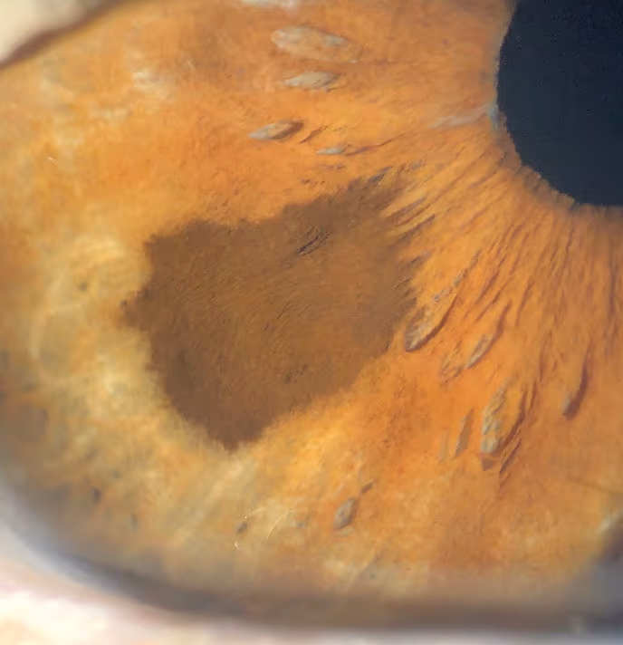 Foto da Íris do paciente mostrando uma lesão acastanhada que é um Nevo de Íris.