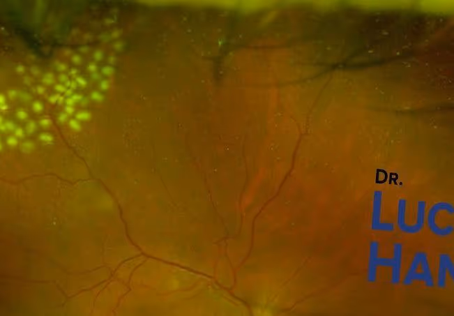 Imagem mostrando caso de descolamento de retina com rasgo em ferradura (horseshoe tear) tratado com fotocoagulação pelo dr. Lucca Ortolan Hansen da Ortolan Oftalmologia. Imagem mostrando caso de descolamento de retina com rasgo em ferradura (horseshoe tear) tratado com fotocoagulação pelo dr. Lucca Ortolan Hansen da Ortolan Oftalmologia.