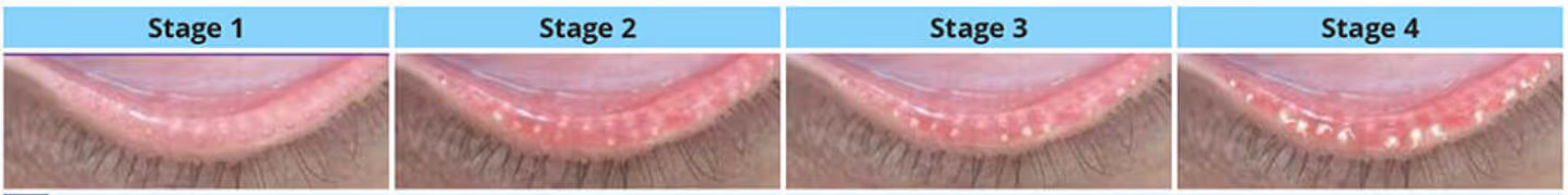 Estágios da blefarite posterior (meibomite): inflamação da margem da pálpebra que gera olho vermelho e coceira.