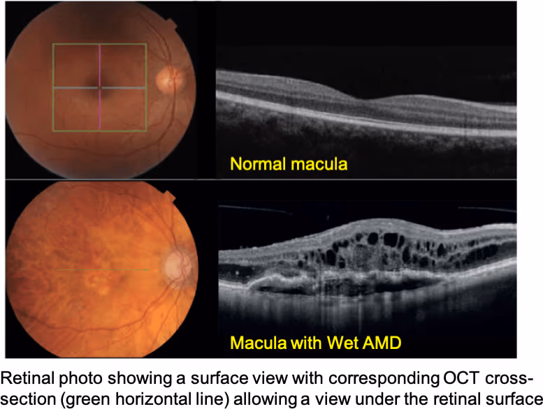 Comparação de retinografia e OCT entre paciente normal e paciente com DMRI.