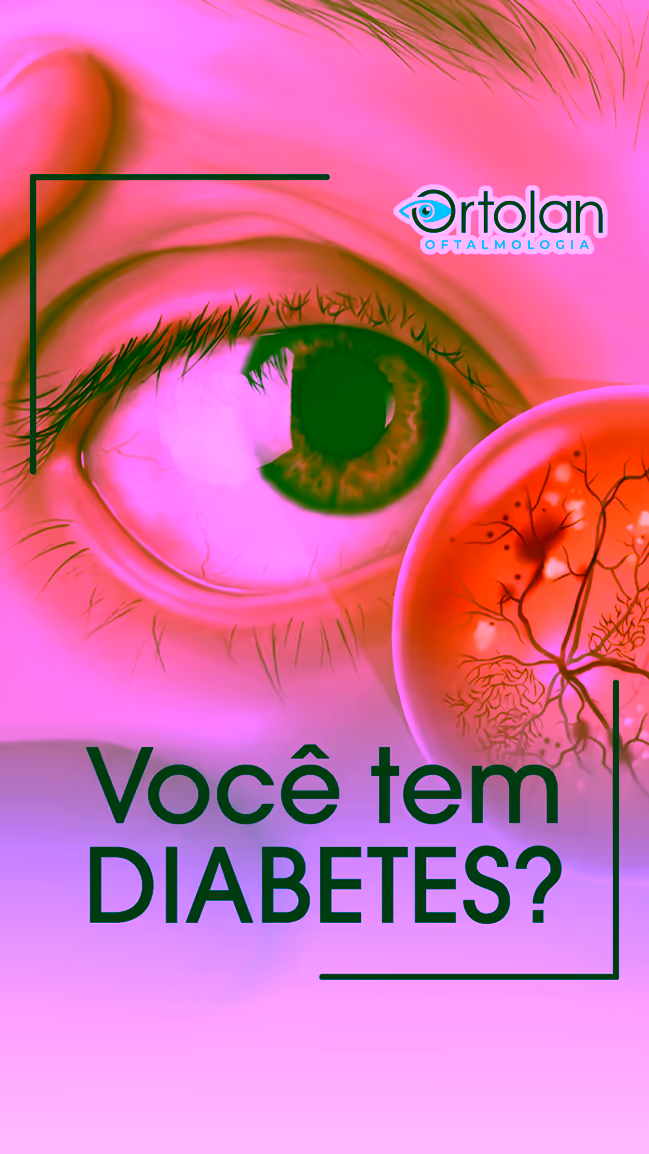 Você tem Diabetes? Sabia que Precisa de Exame Anual da Retina?