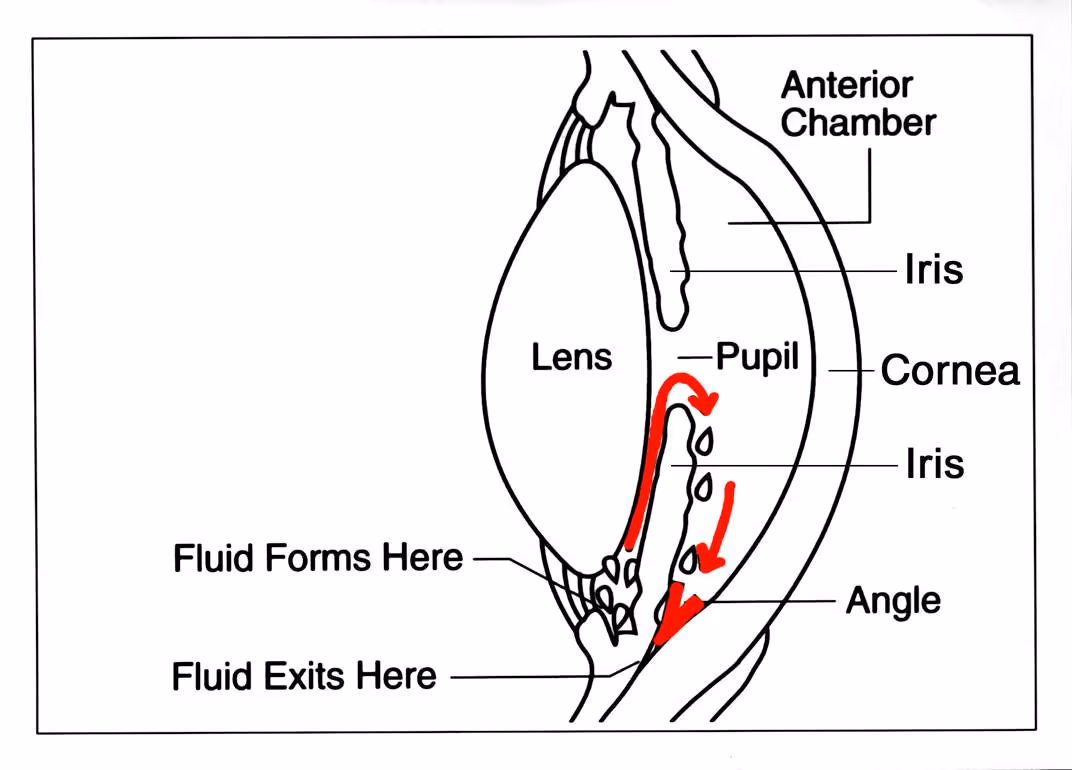 Exemplo de dispositivo de drenagem para glaucoma (Ahmed).