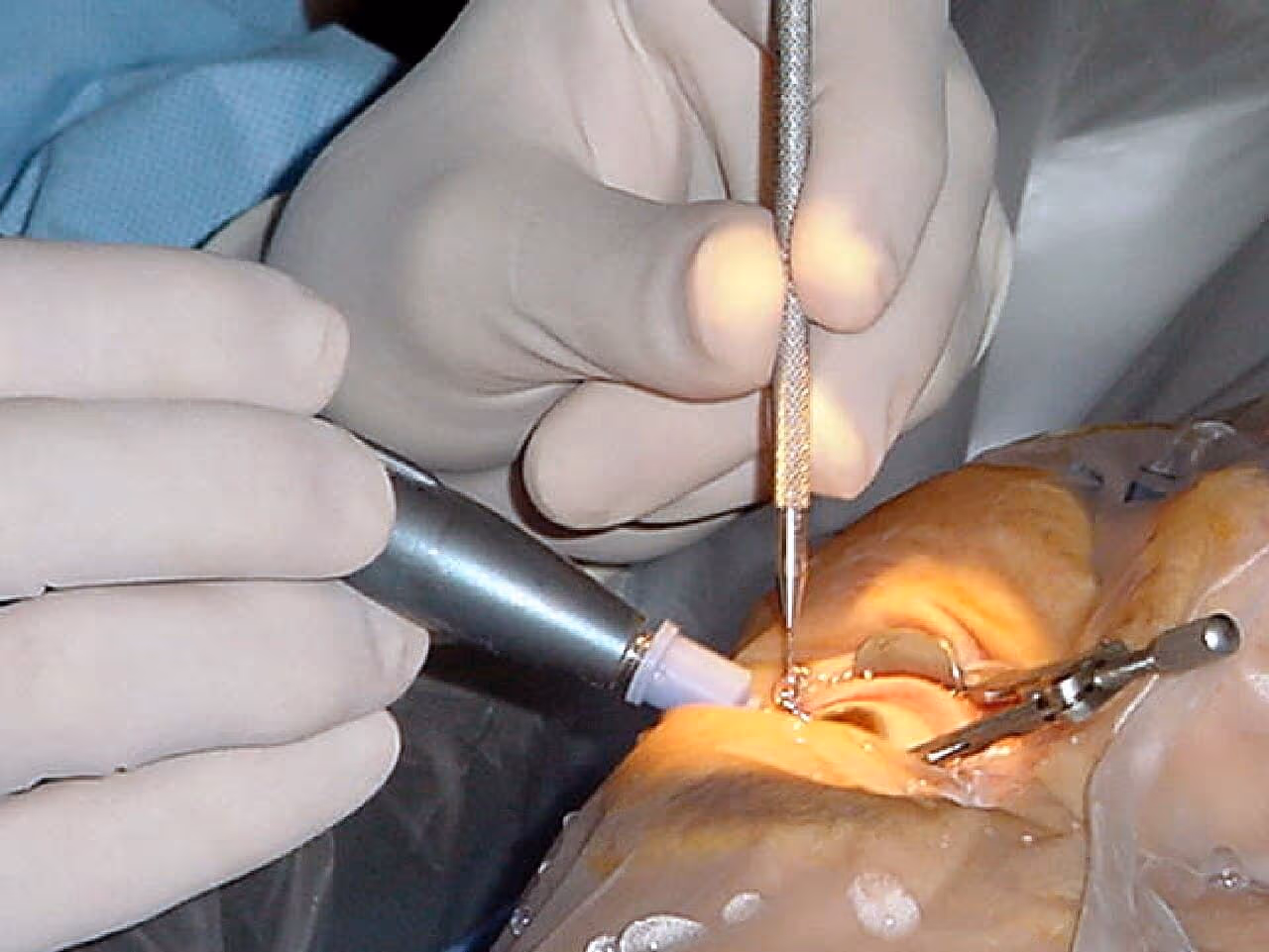 Paciente em equipamento de exame oftalmológico, semelhante ao usado para aplicar a capsulotomia com laser YAG.