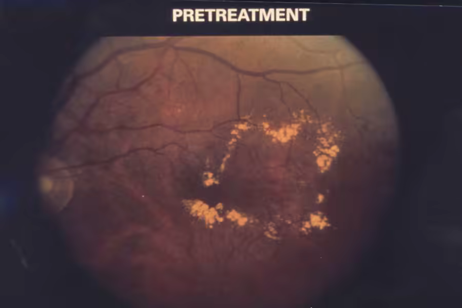 Retinografia de edema macular diabético, uma das indicações do faricimabe.