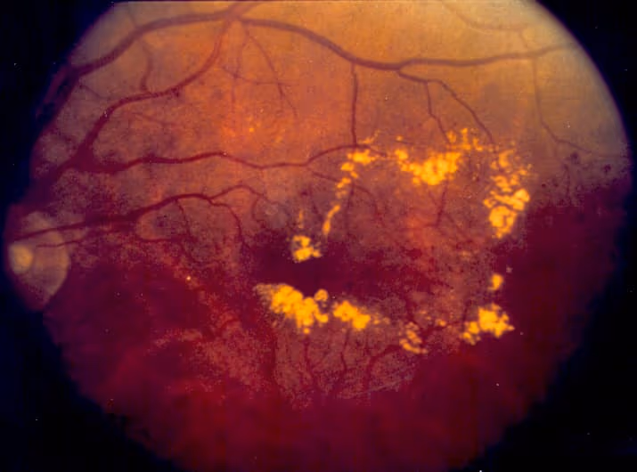 Retina com edema macular em paciente diabético.