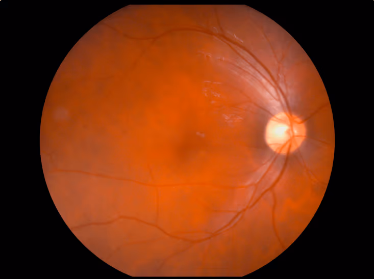 Simulação da visão de um paciente com glaucoma avançado.