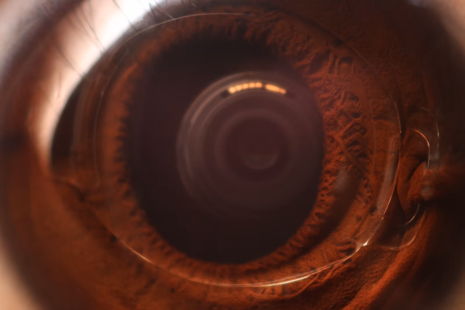 Close de um olho com lente fácica de câmara anterior (modelo iris-claw, mais antigo) implantada e visível à frente da íris. Foto ilustrativa do conceito de lente fácica. A ICL moderna que utilizamos hoje é de câmara posterior, posicionada atrás da íris e não visível externamente desta maneira. Fonte: Isaac K (Iskim86) via Wikimedia Commons. Licença CC BY-SA 4.0.