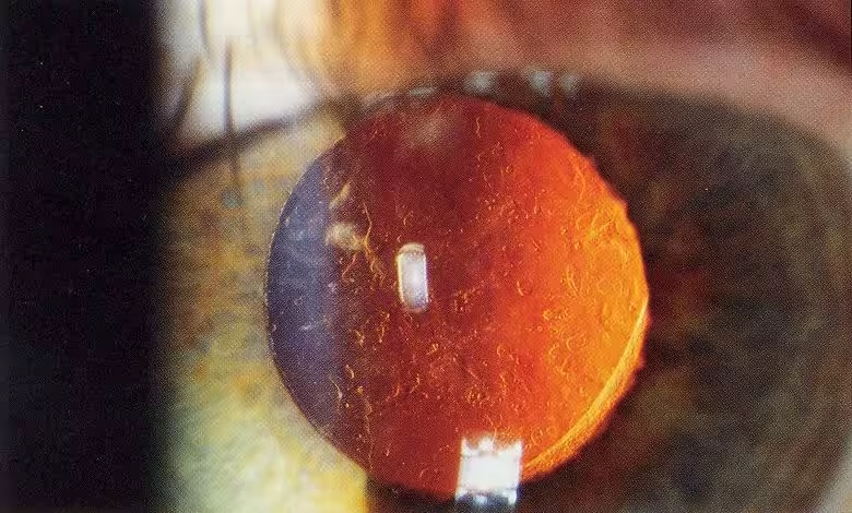 Opacidade de cápsula posterior (OCP) vista em retroiluminação — a 'segunda catarata' que a capsulotomia por Nd:YAG laser trata. Fonte: EyeMD via Wikimedia Commons (CC BY-SA 2.5).