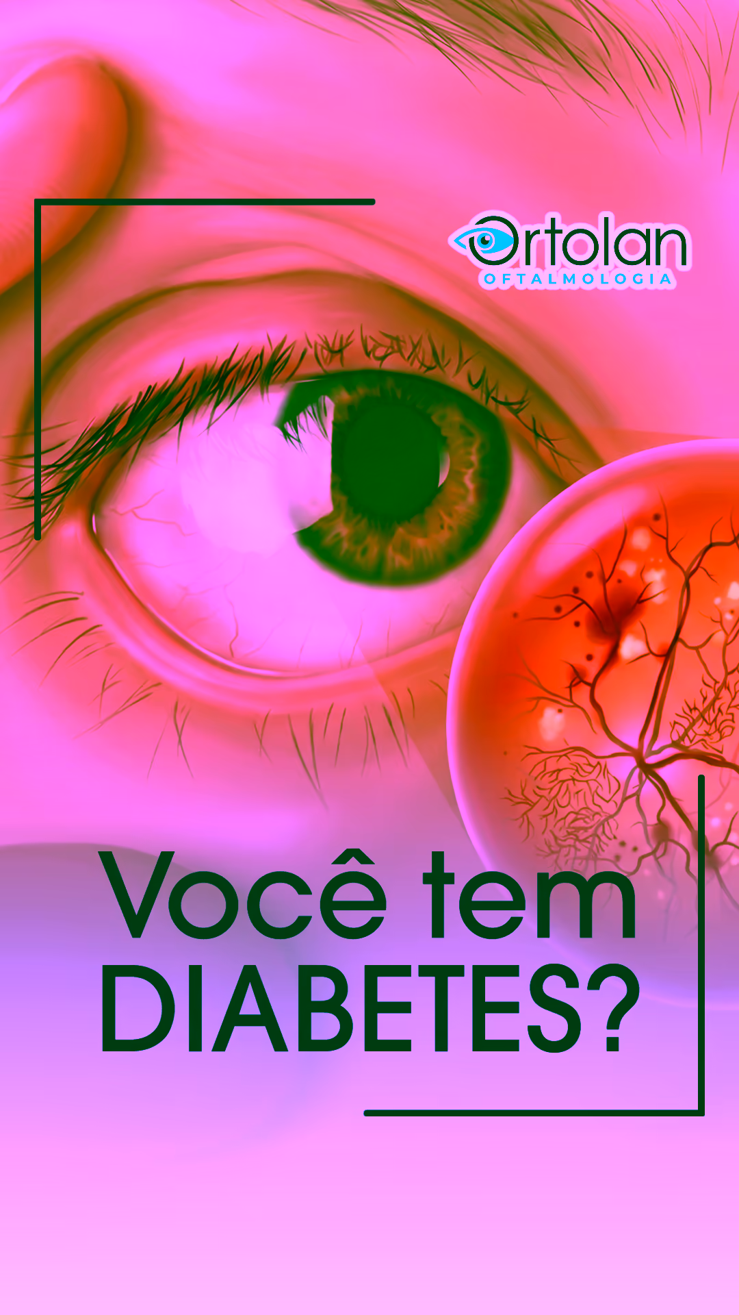 Retina afetada pela retinopatia diabética.