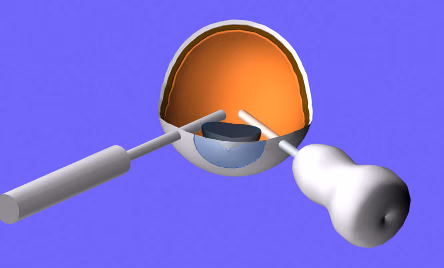 Instrumentação de vitrectomia 23G usada em descolamentos de retina. Instrumentação de vitrectomia 23G usada em descolamentos de retina.
