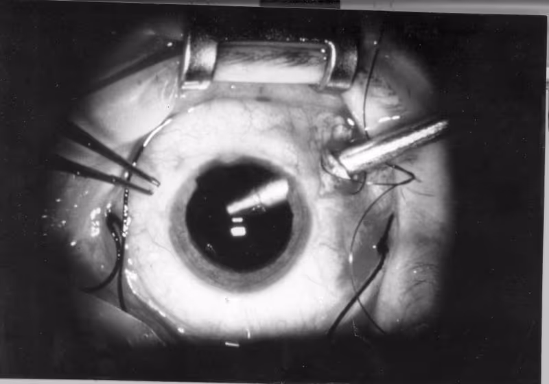 Ambiente cirúrgico de vitrectomia posterior. Ambiente cirúrgico de vitrectomia posterior.