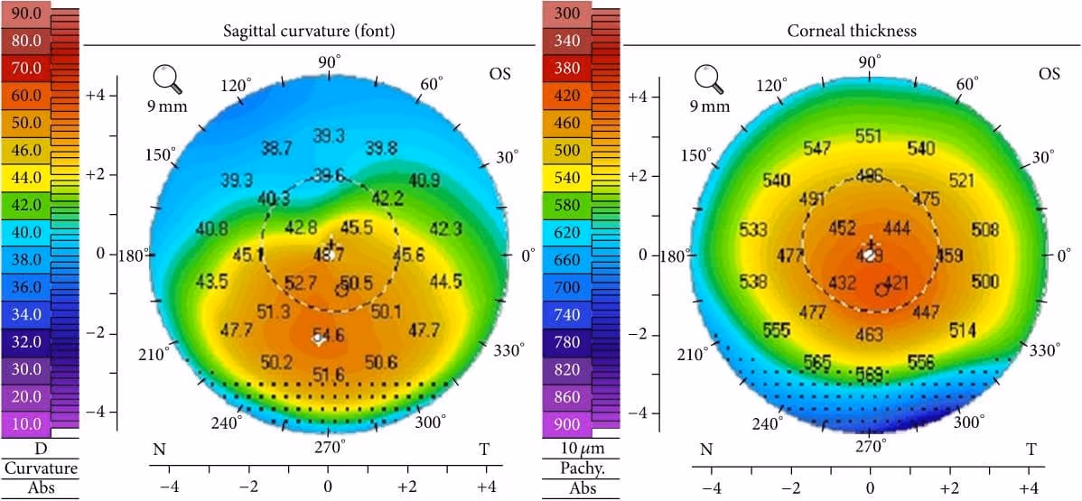 Crosslinking corneano